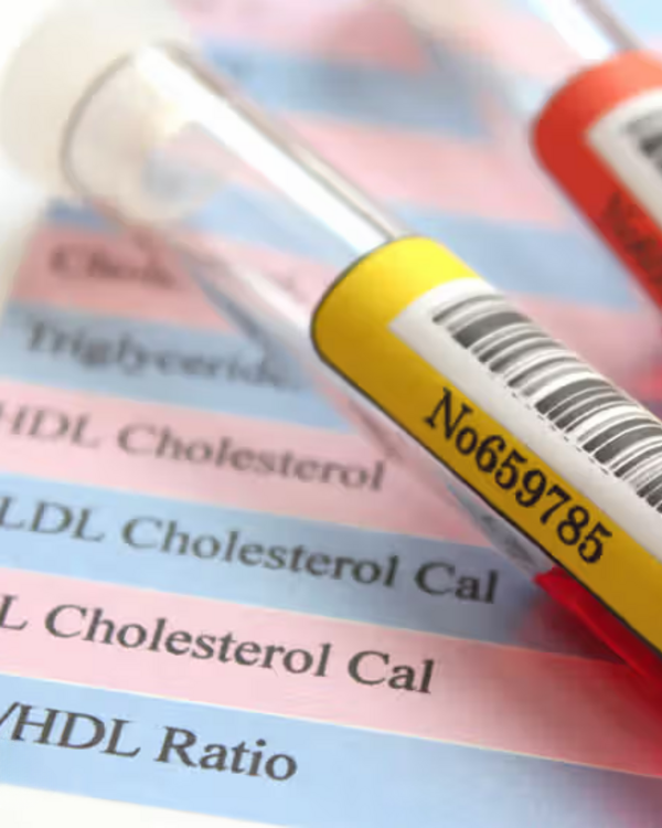 cholesterol test results